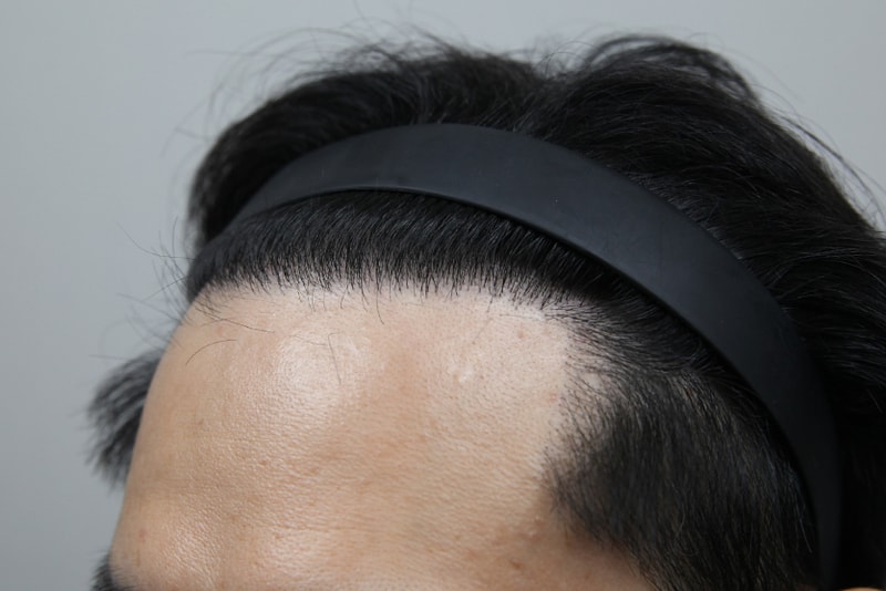 모나라피부과_4000모발이식_8개월경과 (6).jpg