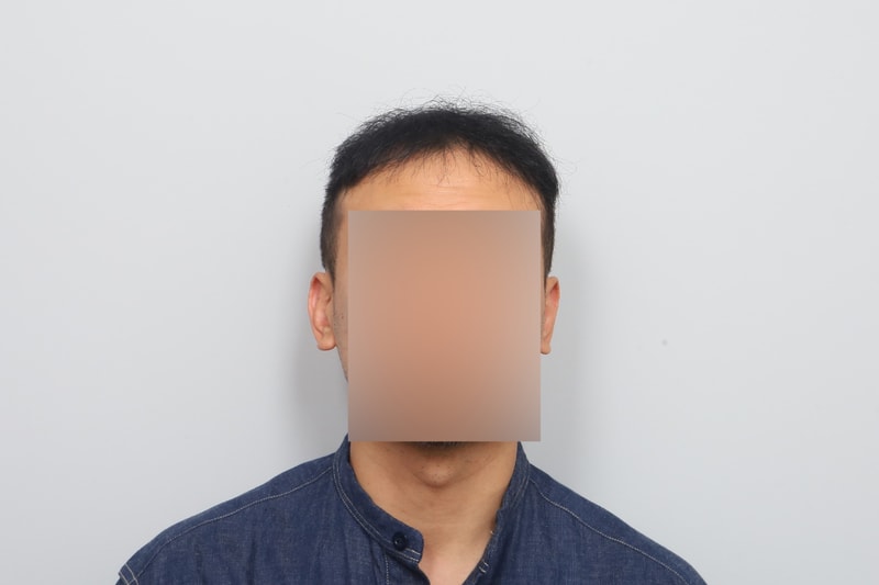 M자탈모 비절개 모발이식 7개월차 모원성형외과 박종옥 원장님