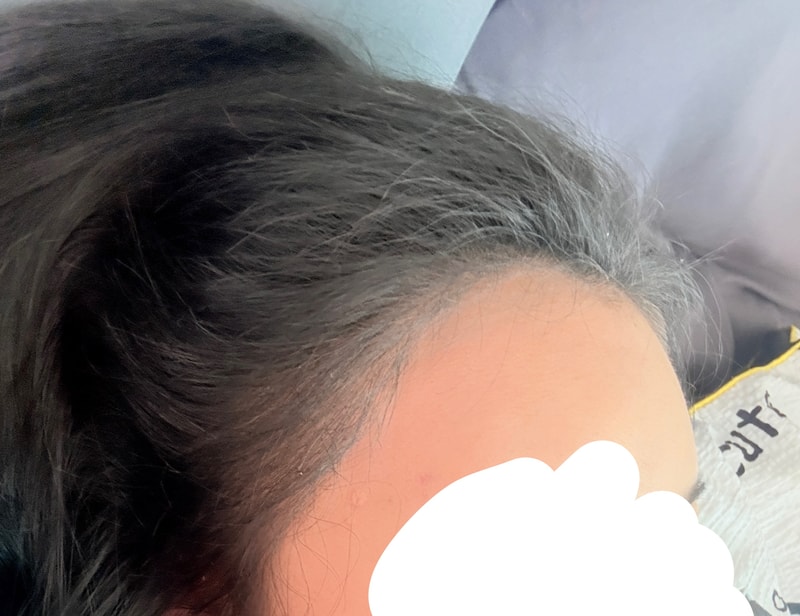 다나 4400모 M자이마 여성 대량이식 생착완료ㅎㅎ(유승현원장님)