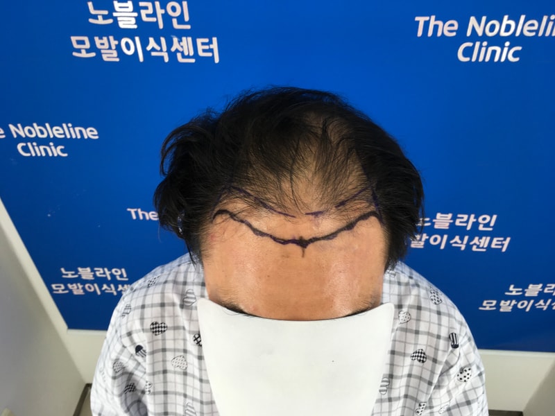 늦게 회복되고 있지만 열심히 관리하고 있습니다. (3개월/5개월/6개월 사진 有)