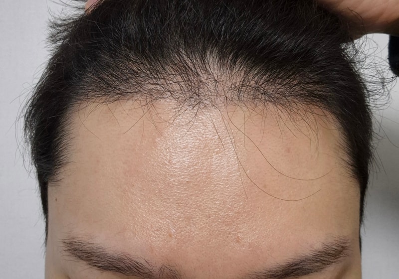 모제림 박세호원장님 6개월차 후기!!