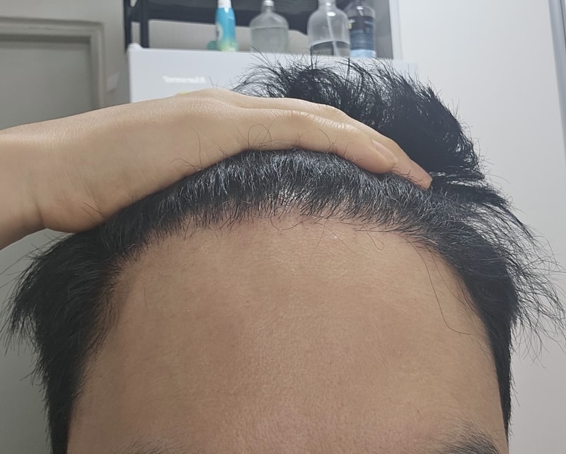 4. 수술후_6개월_셀카_1.jpg
