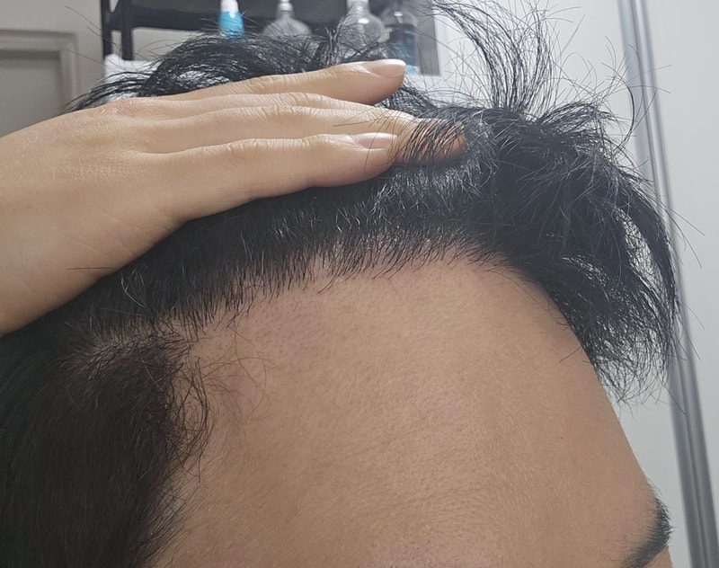 4. 수술후_6개월_셀카_2.jpg