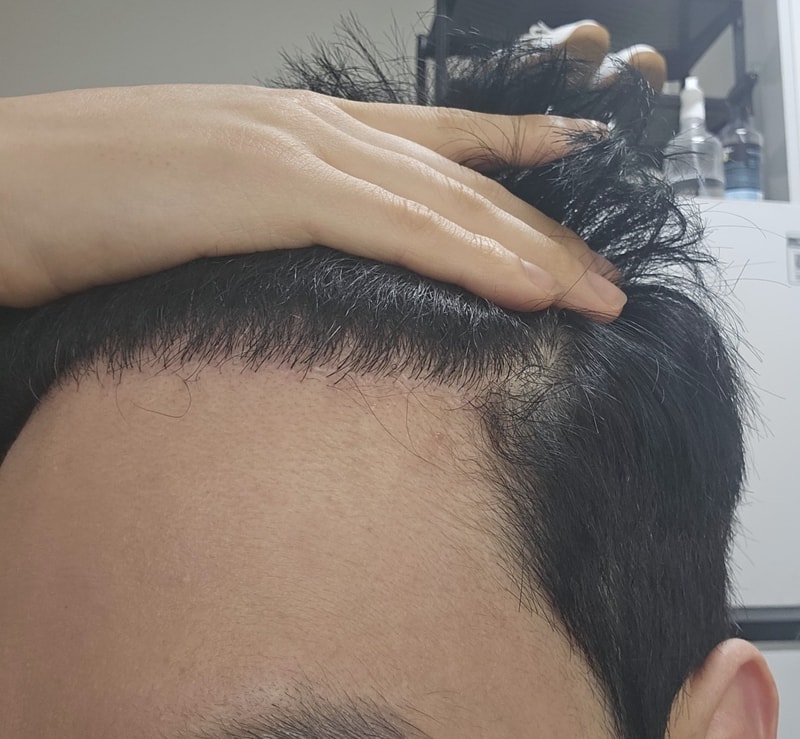 4. 수술후_6개월_셀카_3.jpg