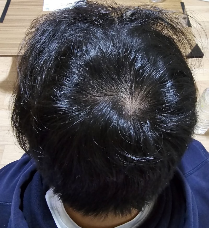 4. 수술후_6개월_셀카_3.jpg