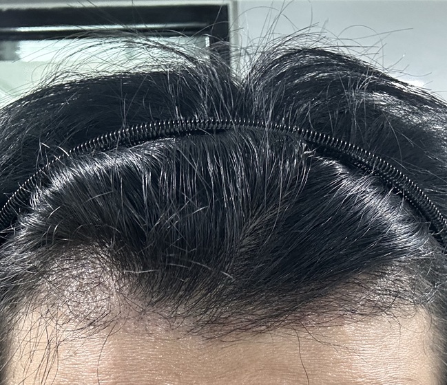 移植後3か月の体験談..