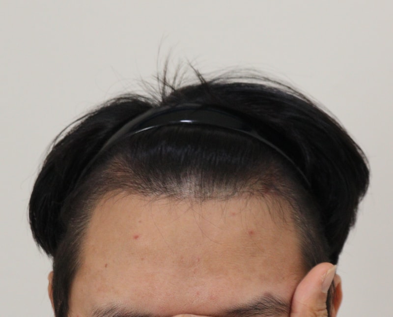 3. 수술후_6개월_1.JPG