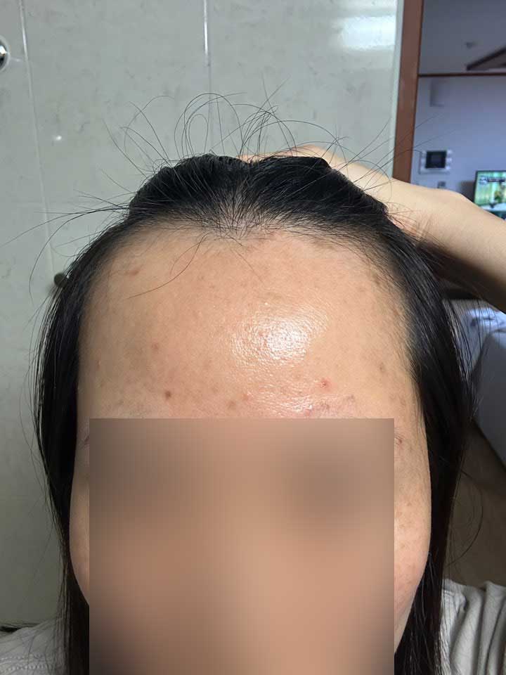 Hairline 1500 Hair follicle-free non-cut Hair Transplant 3 months MO.1 plastic surgery Park Jong-ok, Director