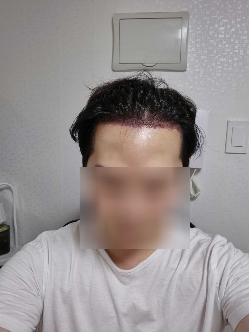 모발이식 재수술 만족도는. (다나 2400모 무삭발 3주경과)