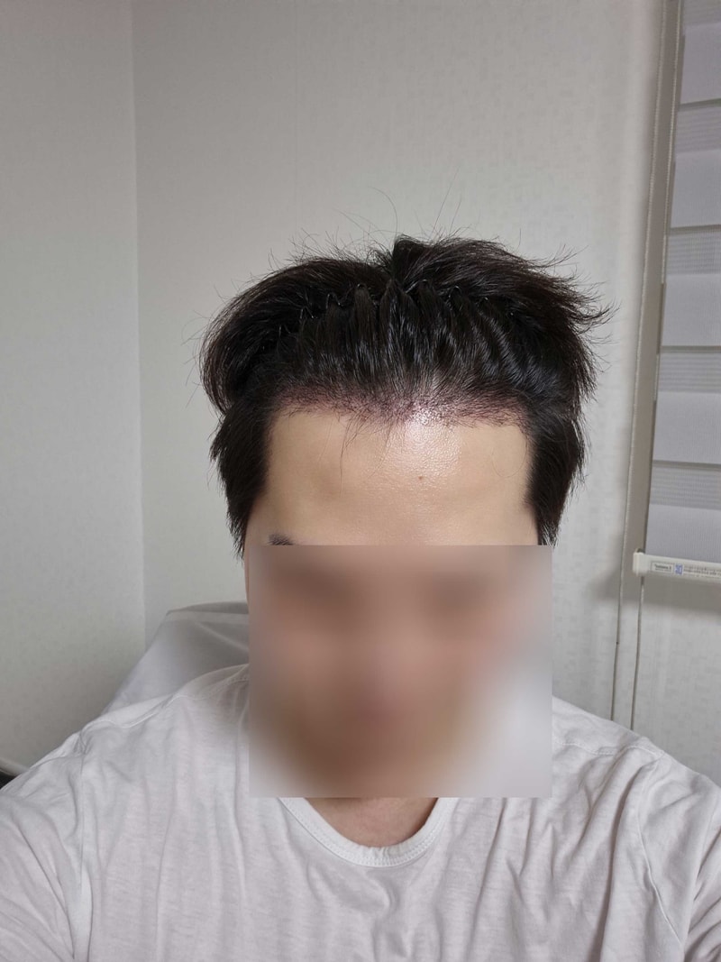 무삭발모발이식21일.jpg