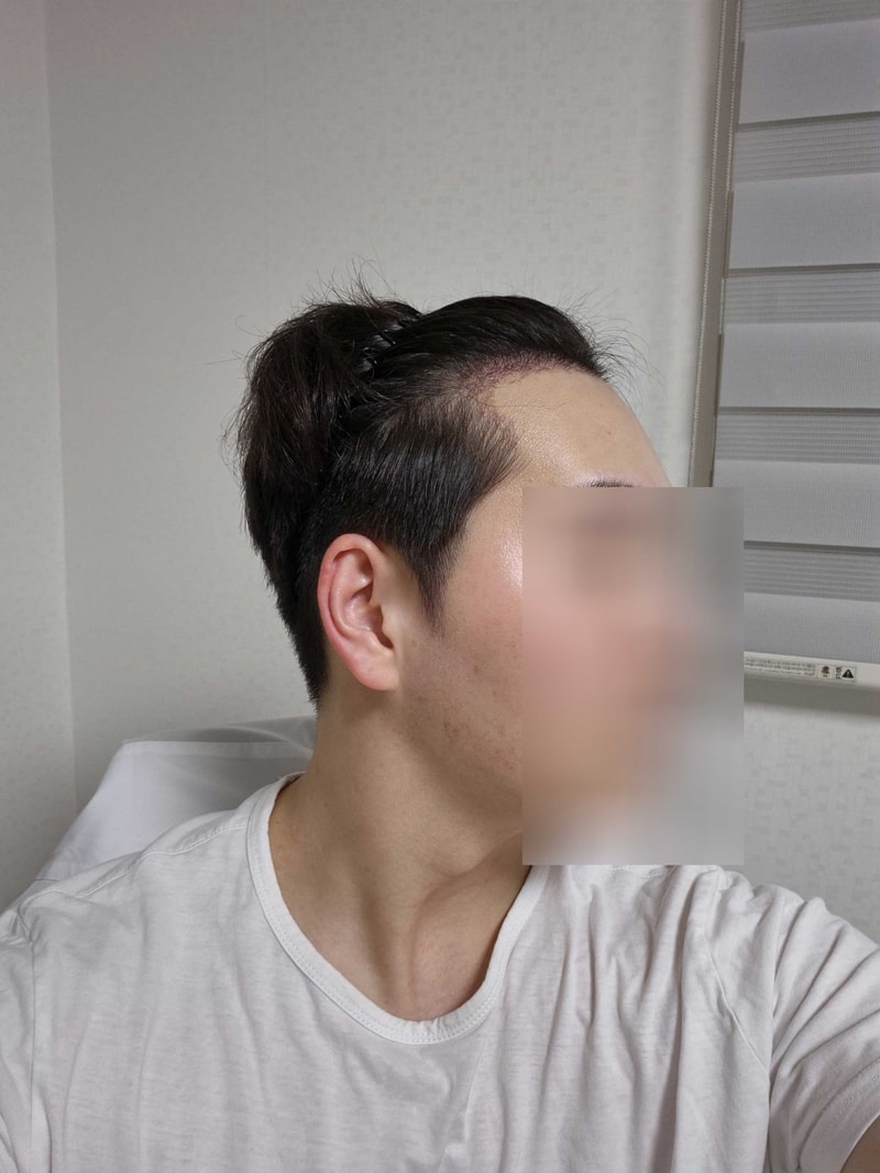 무삭발모발이식21일-3.jpg