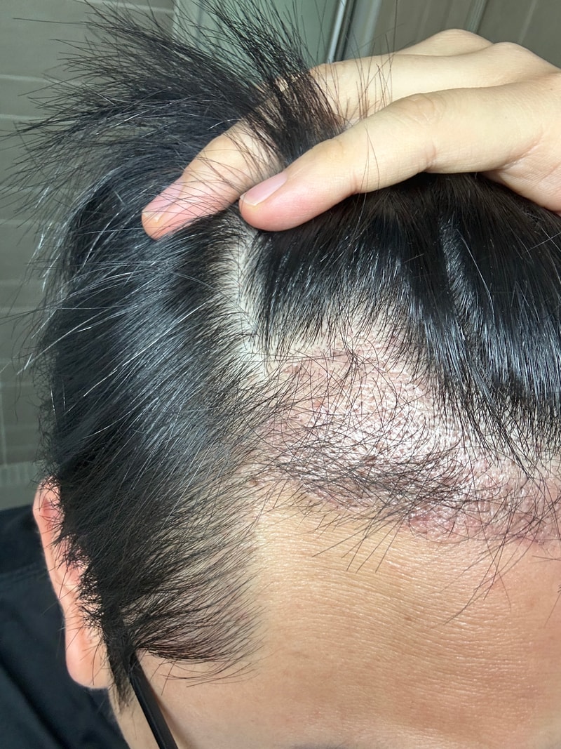 모발이식 90일차 후기 (비절개/1600모낭/강남모발이식병원)