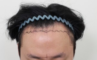 이식 전 정면.jpg