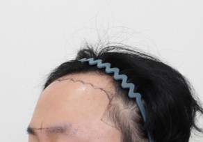 모발 이식 전 측면.jpg