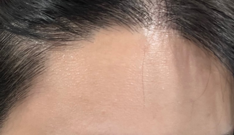 뉴헤어 헤어라인교정 1800모낭 10개월차 후기