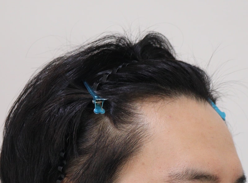 1. 수술전_3.JPG