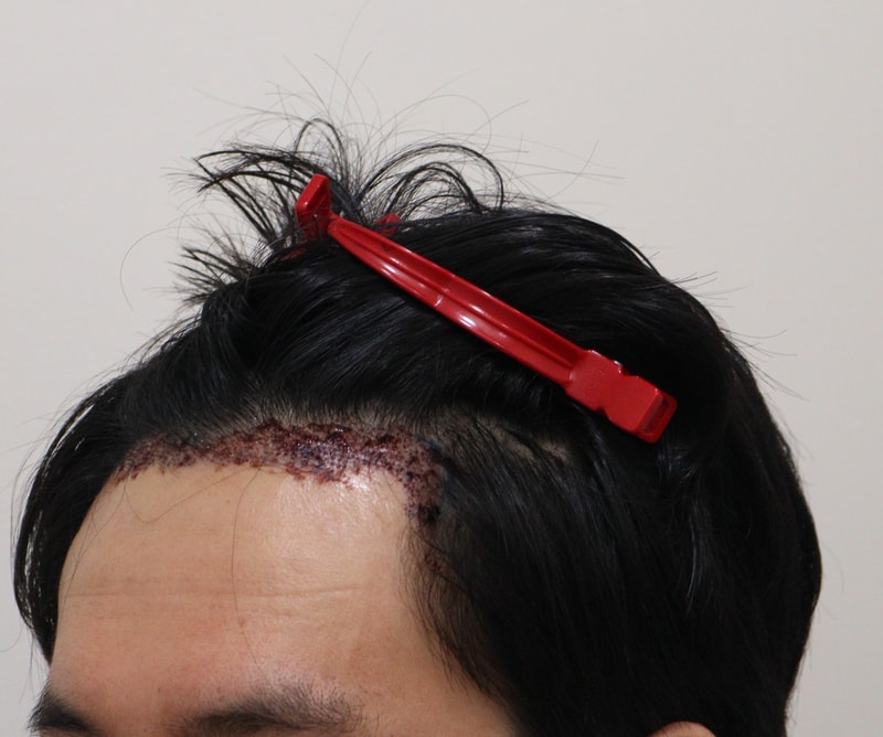 2. 수술후_1일_2.JPG