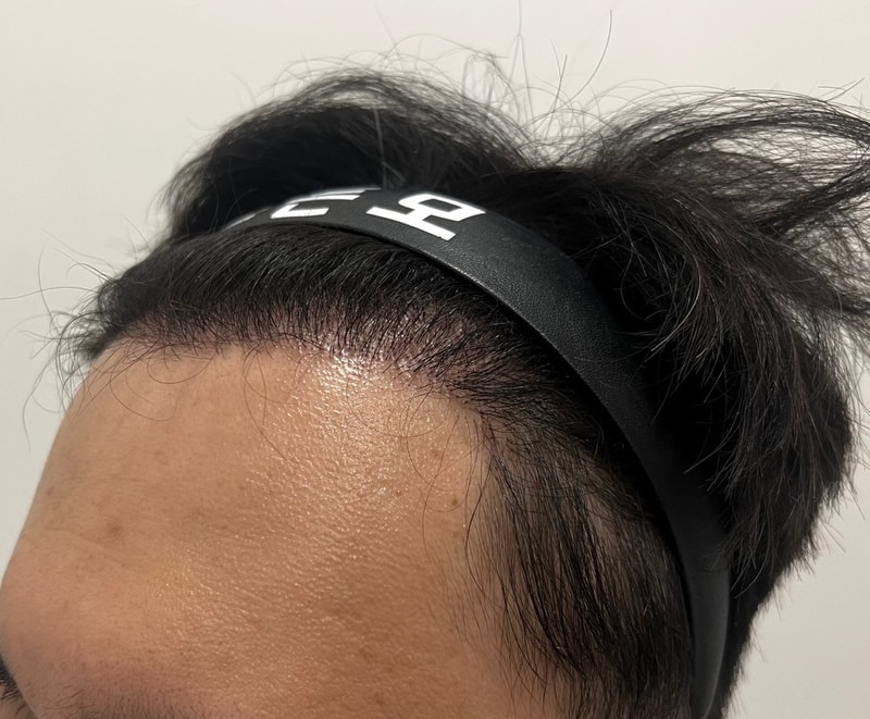 4. 수술후_6개월_2.jpg