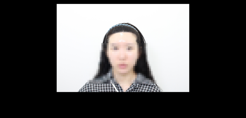 신사역,모프로의원,문건학원장님,헤어라인 비절개 1200모 이식,6개월차 경과