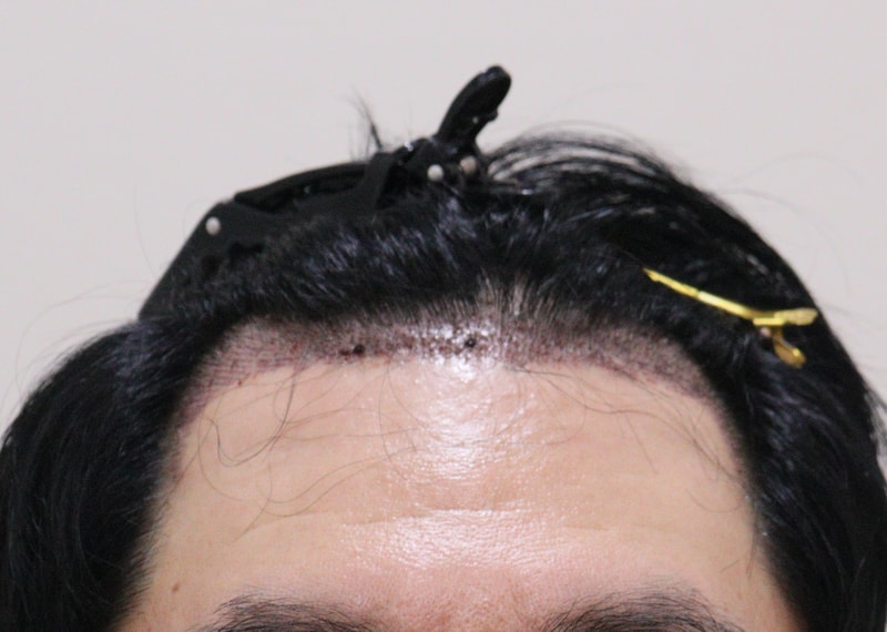 2. 수술후_1일_1.JPG