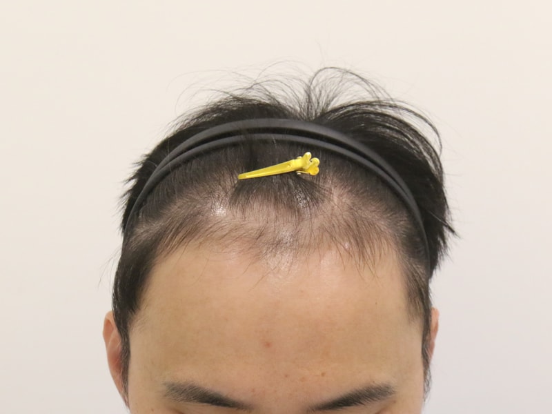 Busan Mammoth Hairline's 4th month of non-cut