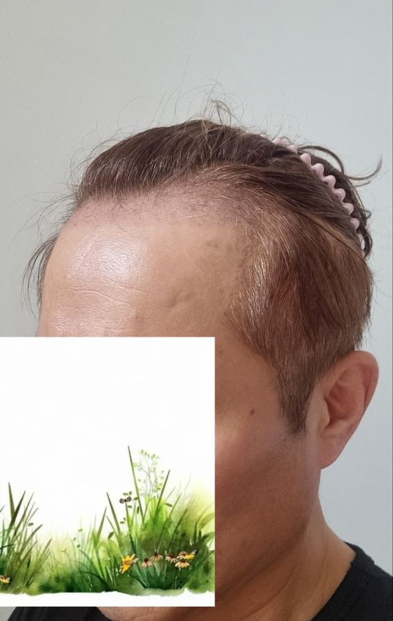 (다나성형외과 비절개모발이식 한달)50대 다 돼서 머리심었더니... 