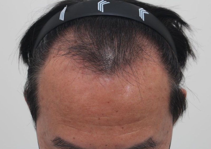  50대 남자 부산 포헤어의원 M자탈모 비절개슬릿 모발이식 1년차 후기 