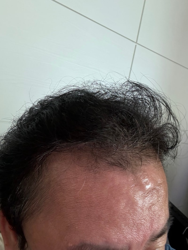 3. 수술후_6개월_셀카_1.jpg