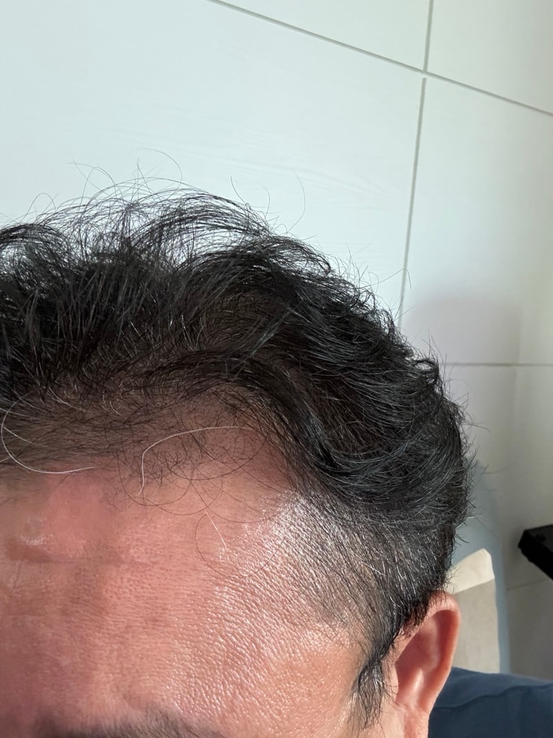 3. 수술후_6개월_셀카_2.jpg