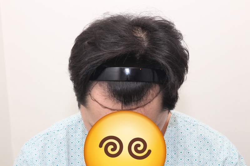 모발이식 1600모낭 1년2개월 경과 후기