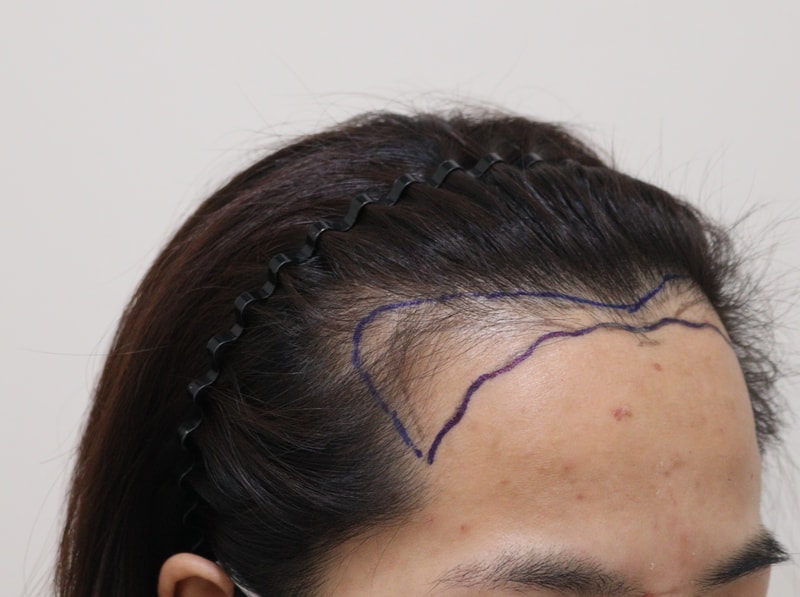 1. 수술전_3.JPG