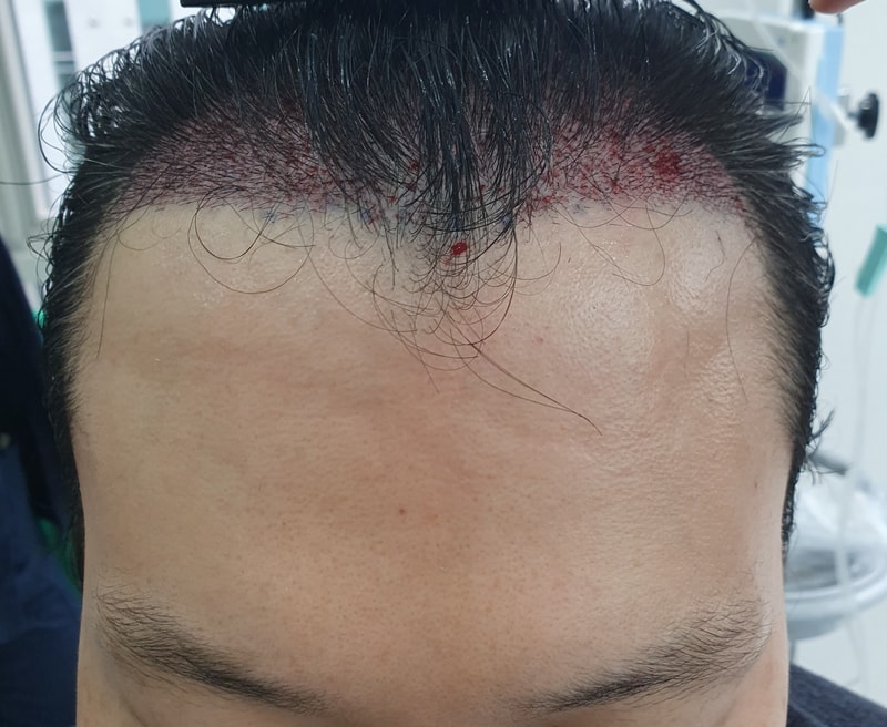 수술직후.jpg