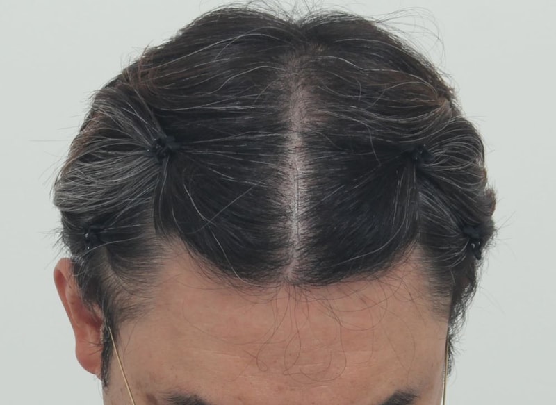 2.수술후.JPG