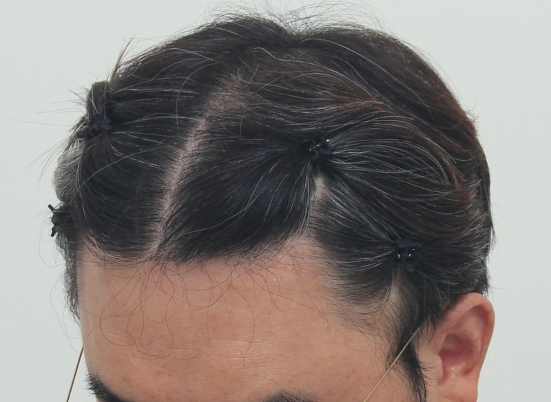 3.수술후.JPG