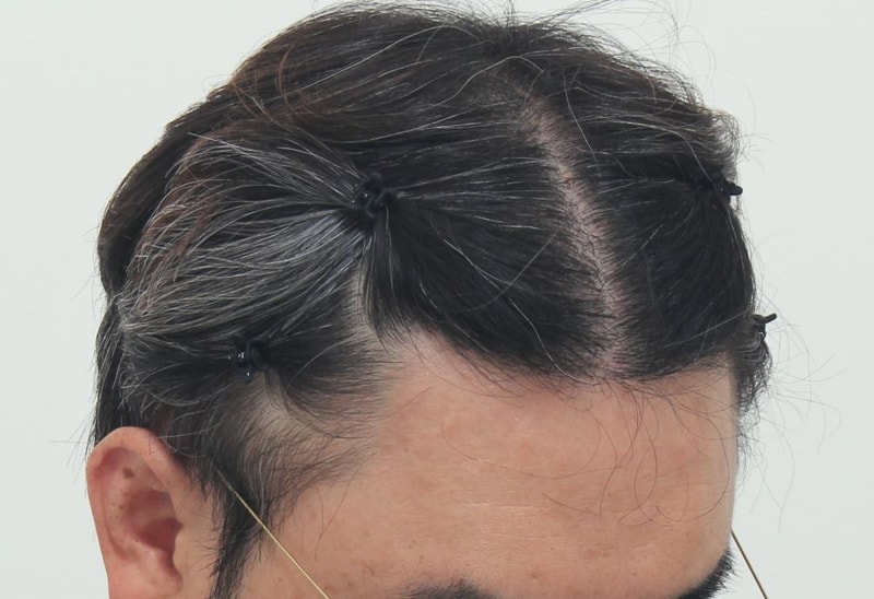 4.수술후.JPG