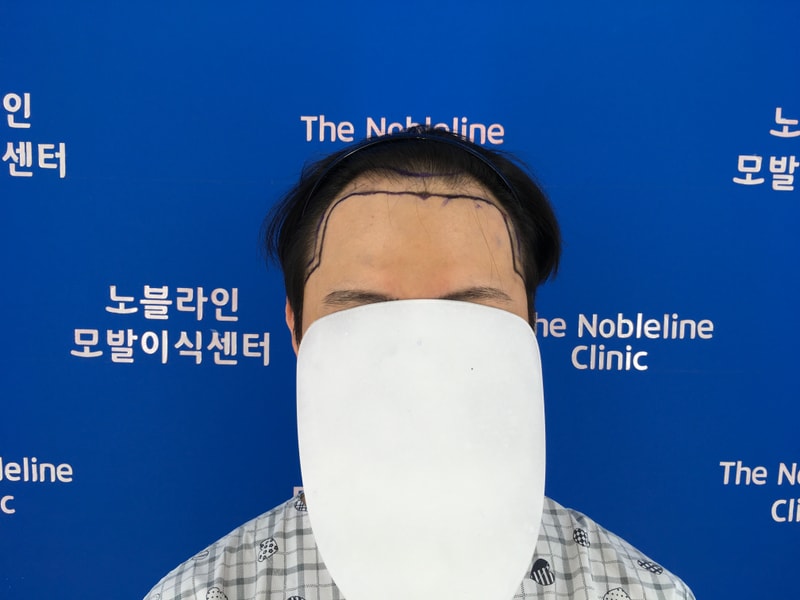노블라인 모발이식 200일 경과 입니다.