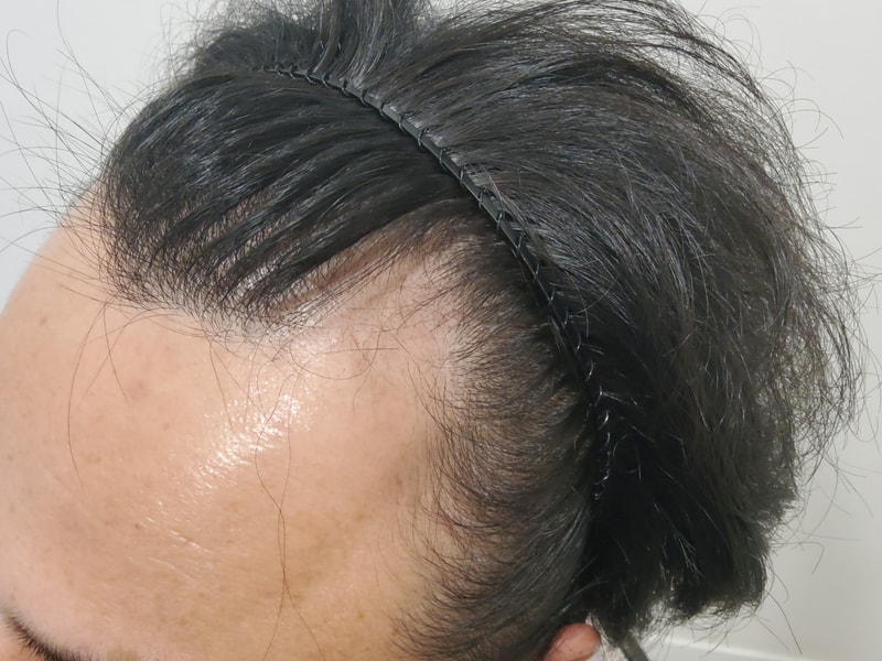 1. 수술전_2.jpg