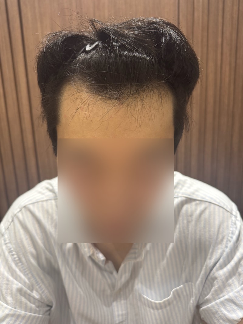 무삭발 1400모낭 비절개 모발이식 4개월 모원성형외과 정재홍원장님