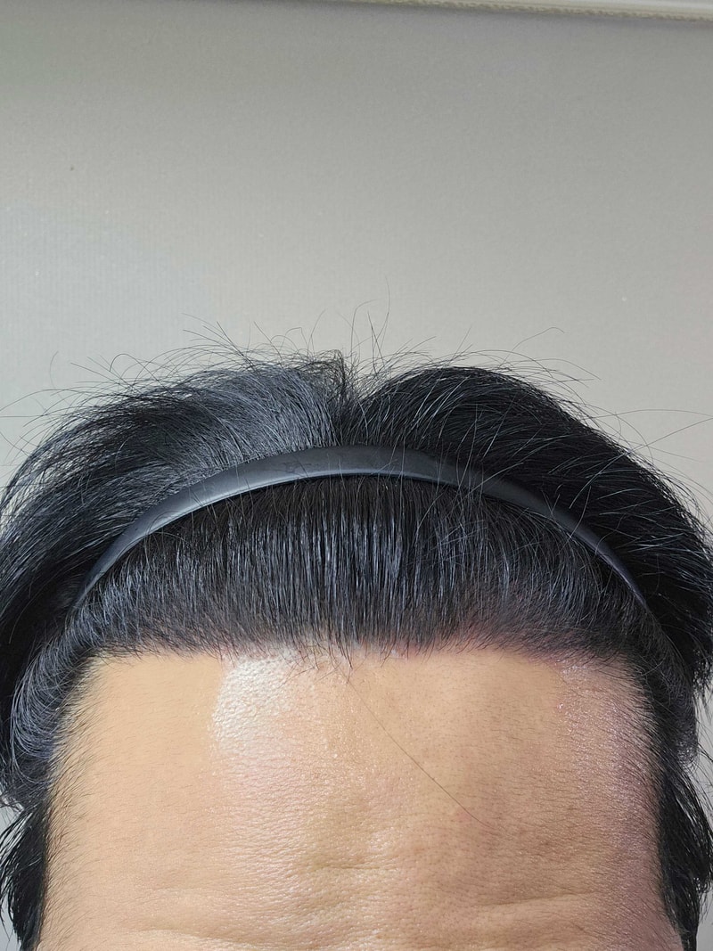 다나에서모발이식.jpg