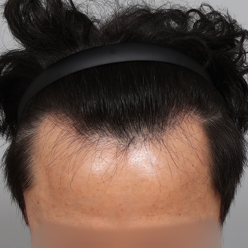 이마 라인 고민 해결 서진성형외과 모발이식 1년 경과