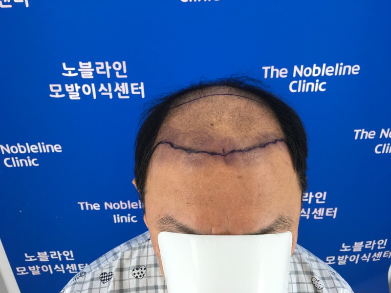 27년차 가발탈출 15개월 후기 - 말이 필요 없습니다. 사진으로 올립니다!