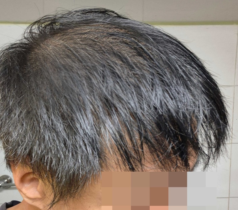 비절개모발이식후기.jpg