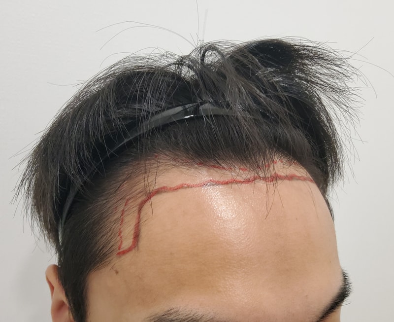 1. 수술전_2.jpg