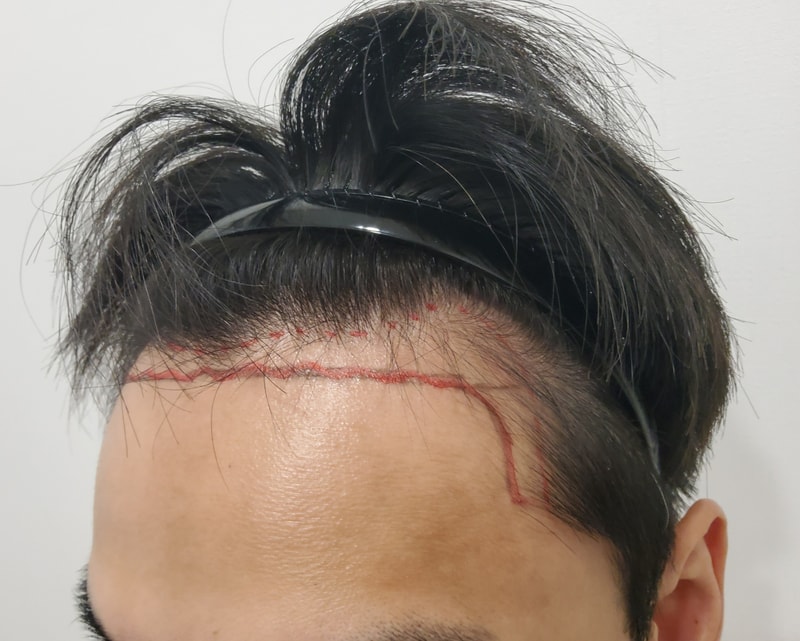 1. 수술전_3.jpg