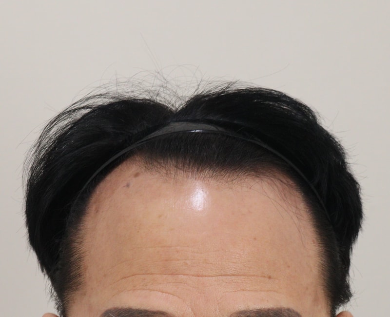 1. 수술전_1.JPG