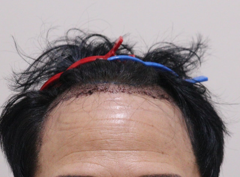 2. 수술후_1일_1.JPG