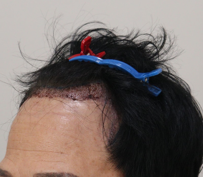 2. 수술후_1일_2.JPG