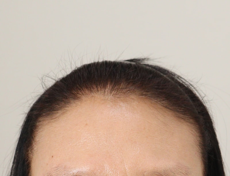 1. 수술전_1.JPG