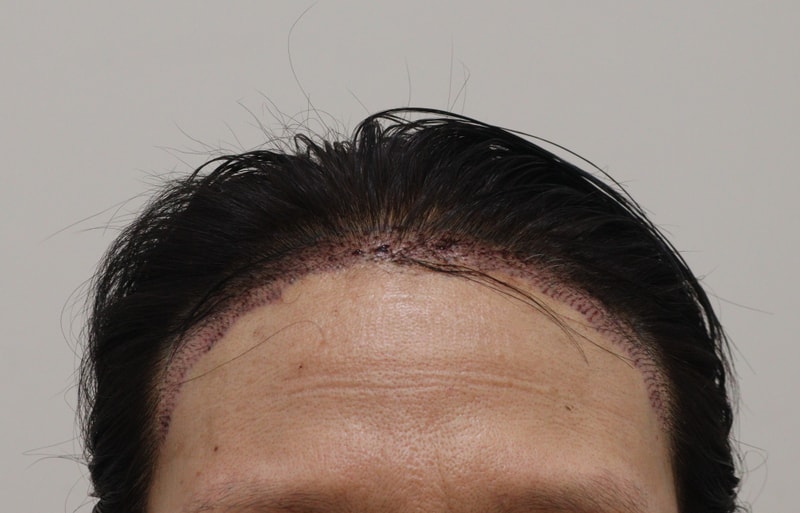 2. 수술후_1일_1.JPG