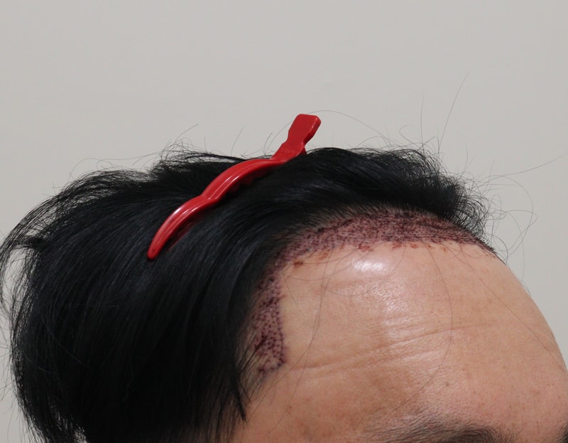 2. 수술후_1일_3.JPG